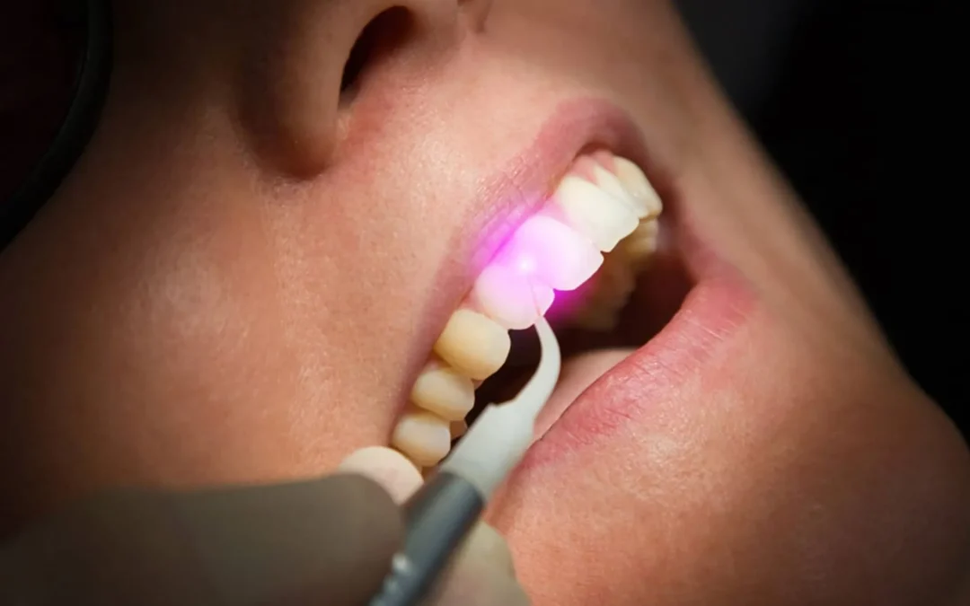 Terapia Fotodinamica in Parodontologia: Un Trattamento Innovativo per la Salute delle Gengive