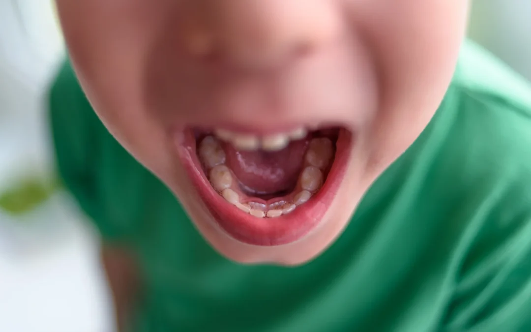 Sigillatura dei Denti nei Bambini: Proteggi i Molari dalle Carie